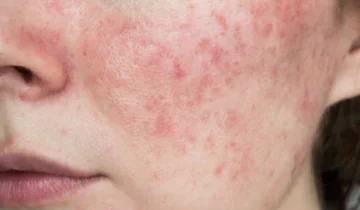 Rosacea: cos’è e quali sono i rimedi